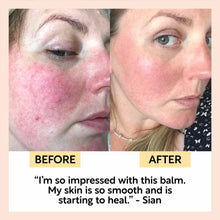 Load image into Gallery viewer, Before and after comparison of a person's skin with a positive testimonial about a balm.