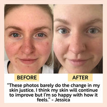 Load image into Gallery viewer, Before and after comparison of a person's skin with text overlay.
